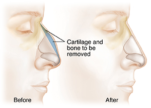 Side view of head showing the before and after of a rhinoplasty. Nose cartilage to be removed highlighted in blue.