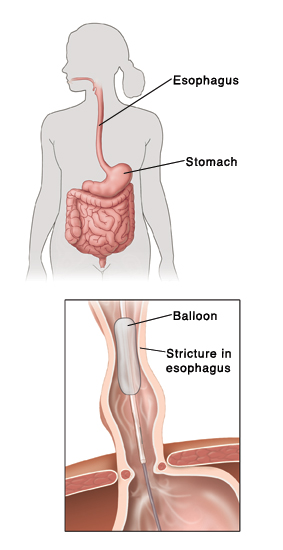 A balloon dilator may be used to widen a stricture in the esophagus. Outline of human figure showing digestive system. Inset shows balloon widening stricture in esophagus.