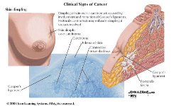 (Click for larger image) Skin dimpling may be a sign of breast cancer. Image of clinical signs of cancer