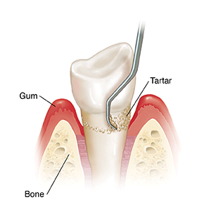 Side view of tooth in bone showing instrument doing planning.