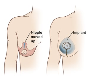 Breast lift, showing incisions and nipple moved up, and breast implant, showing incisions.