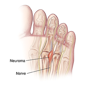 Bottom view of foot showing neuroma between toe bones.