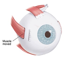 Three-quarter view of eye showing muscle on outside of eye. Muscle has been cut, moved back, and sutured (sewn) to sclera.