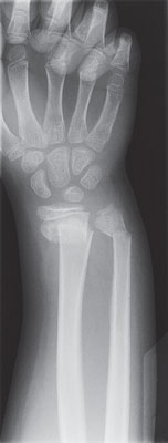 X-ray of an arm and hand showing a broken wrist