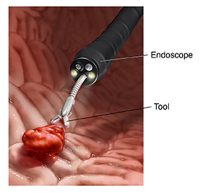 Closeup of endoscope tip in stomach with instrument grasping tissue for biopsy.