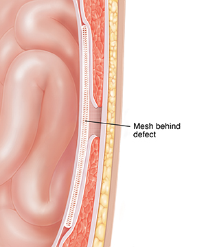 Cross section of abdominal wall showing mesh repair behind hernia defect.