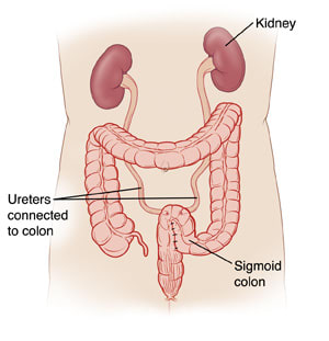 Front view of belly, showing no bladder and kidneys connected to sigmoid colon by ureters.