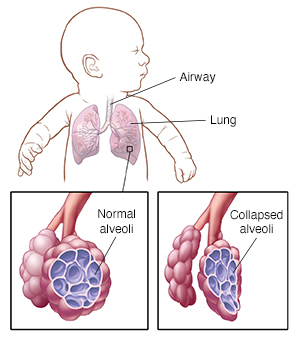 Baby’s respiratory system showing airway and lungs, with detail of normal alveoli and collapsed alveoli.