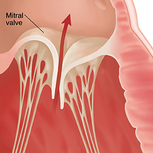 Close-up of heart valve unable to close all the way. Arrow shows blood flowing backwards through valve.