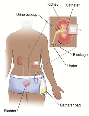 Back view of person showing their urinary tract with a nephrostomy tube and catheter bag in place. Inset shows close up of kidney with a blockage and nephrostomy tube.