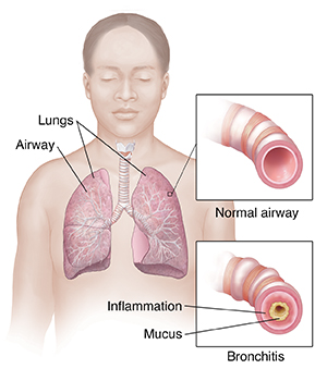 Front view of person showing respiratory system. Insets show normal airway and airway with bronchitis.