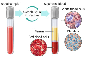 A sample of blood is taken and spun in a machine to separate the blood into plasma, white blood cells, platelets, and red blood cells.