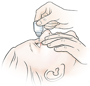 Person leaning head back and pulling down on lower eyelid, while other hand is squeezing eyedrops from container into eye. 
