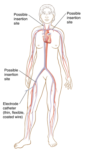 Front view of female outline showing heart, major arteries and veins. Catheter inserted in femoral vein going to right heart.