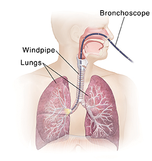Front view of male head and torso showing respiratory system with bronchoscope inserted through nose, down trachea, and into right main bronchus.