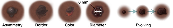 Mole with asymmetrical shape. Mole with uneven, blurry borders. Mole with dark and light spots. Mole with 6 mm measurement across diameter. Three moles showing changes in mole over time.