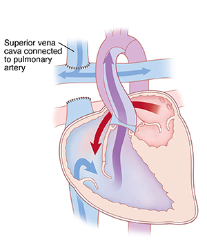 Cross section of heart showing bidirectional Glenn procedure, in which superior vena cava is connected to pulmonary artery.