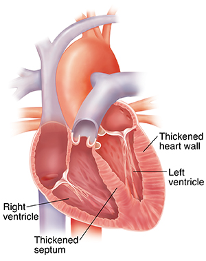 Cross section of heart with thick ventricle walls.