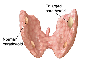 Back view of thyroid showing three normal parathyroids and one enlarged one.