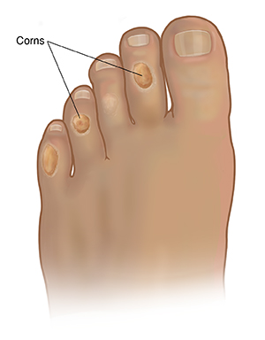 Top view of foot showing corns on four smaller toes.
