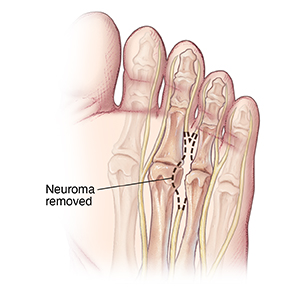 Bottom view of foot showing neuroma between toe bones.