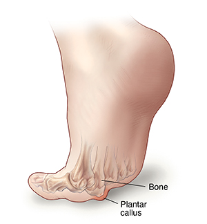 Bottom view of flexed foot showing plantar callus on ball of foot.