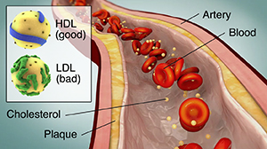 Cross section of artery showing plaque buildup and blood flow. Inset shows HDL and LDL molecules.