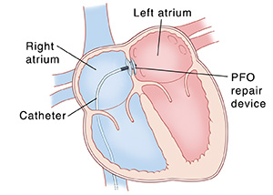 Four chamber view of cross section of heart showing catheter inserting a patent foramen ovale closure device. 