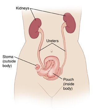 Front view of female torso, showing kidneys connected by ureters to pouch inside body and stoma outside body.