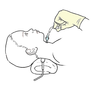 Child lying on back with pillow under neck, gloved hand inserting new trach tube into child's neck.