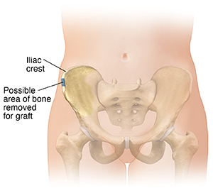 Front view of female lower abdomen showing pelvic bones. Blue area shows possible bone graft donor site.