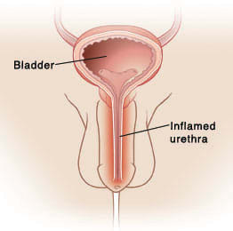 Front cross-section of male anatomy, showing inflamed urethra going from bladder through penis to outside body.