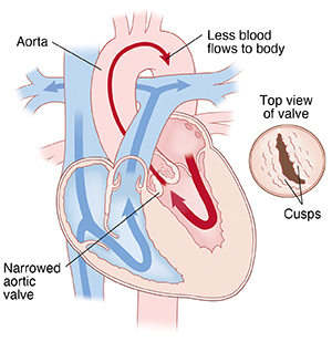 Four-chamber view of heart showing bicuspid aortic valve. Arrows indicate less blood flowing through aortic valve. Inset shows top view of bicuspid valve.