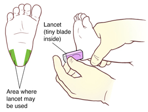 Bottom view of infant's foot showing areas on heel where lancet may be used, with gloved hands holding lancet against infant's heel.