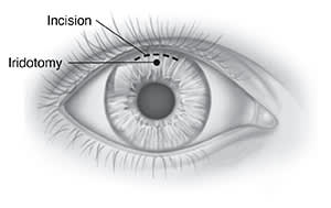 Front view of eye showing incision at top of iris, and hole for iridotomy.