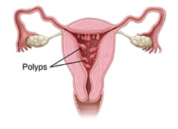 Front view cross section of female reproductive organs showing polyps in uterus.