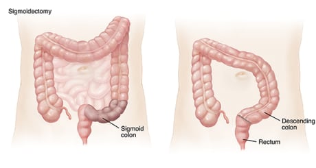 Outline of adult abdomen showing large and small intestines. Shaded area on sigmoid colon shows sigmoidectomy. Outline of adult abdomen showing descending colon attached to rectum after sigmoidectomy.