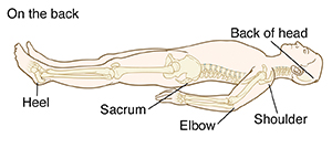 Outline of person lying on back with bones visible. Pressure points: Back of head, shoulder, elbow, sacrum, and heel.