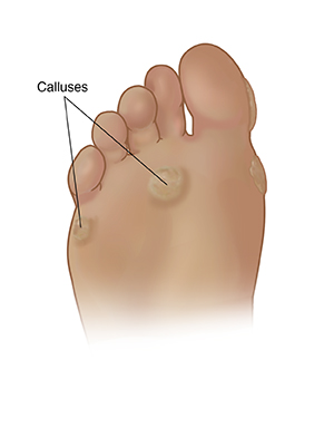 Bottom view of foot showing calluses on ball of foot and side of foot.