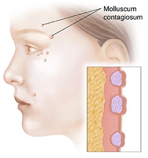 Molluscum contagiosum bumps near person's eye and mouth. Inset shows cross section of bumps.