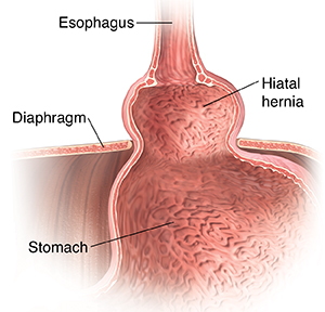 Closeup cross section of top part of stomach, lower esophagus, and diaphragm showing hiatal hernia.