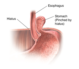 Cross section of stomach, esophagus, and diaphragm showing a paraesophageal hernia.