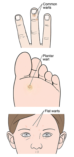 Common wart on end of finger. Plantar wart on sole of foot. Flat warts on face.