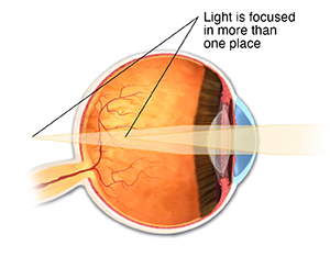 Cross section of eye showing astigmatism, with light focusing in more than one place.