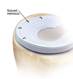 Top view of meniscus showing sutures used to repair tear.