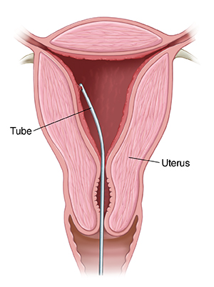 Cross section of cervix with endometrial biopsy tube.