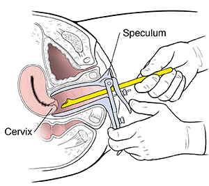 Cross section of female pelvis showing hands taking cervical sample for pap test.
