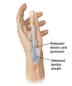 Side view of hand showing tendon sheath cut over tendons in base of thumb to repair de Quervain's tenosynovitis.