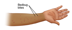 Forearm showing bedbug bites.