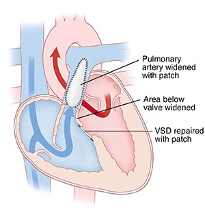 Cross section of heart showing tetralogy of Fallot repair. 